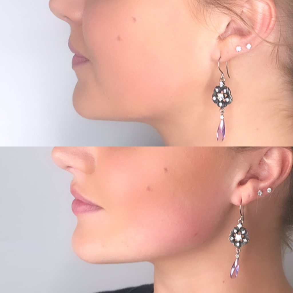 Jawline Contouring