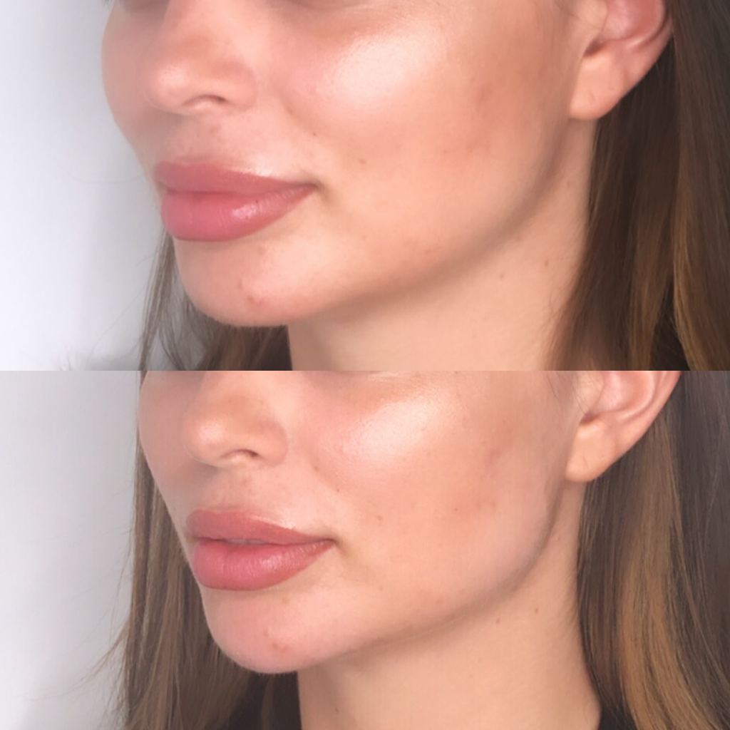 Jawline Contouring
