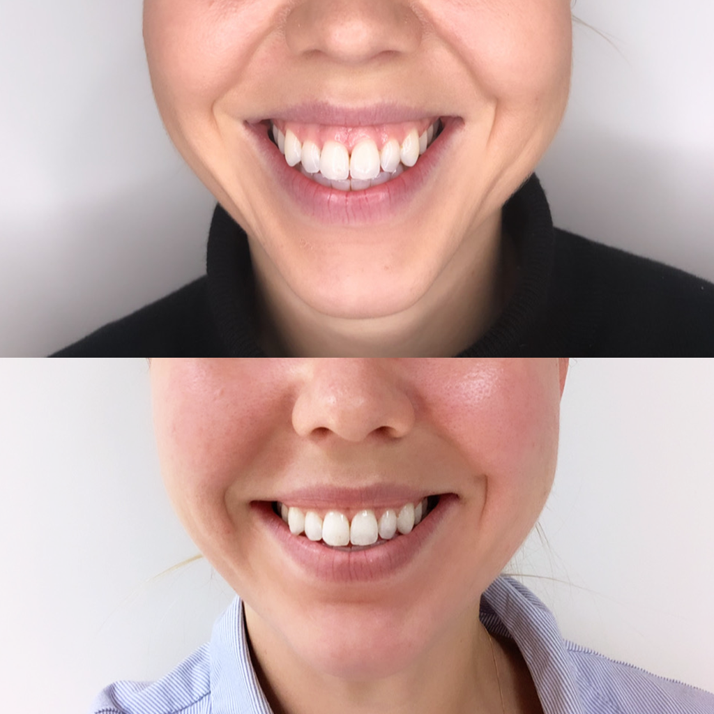 Gummy Smile